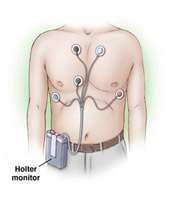 Holter Monitor
